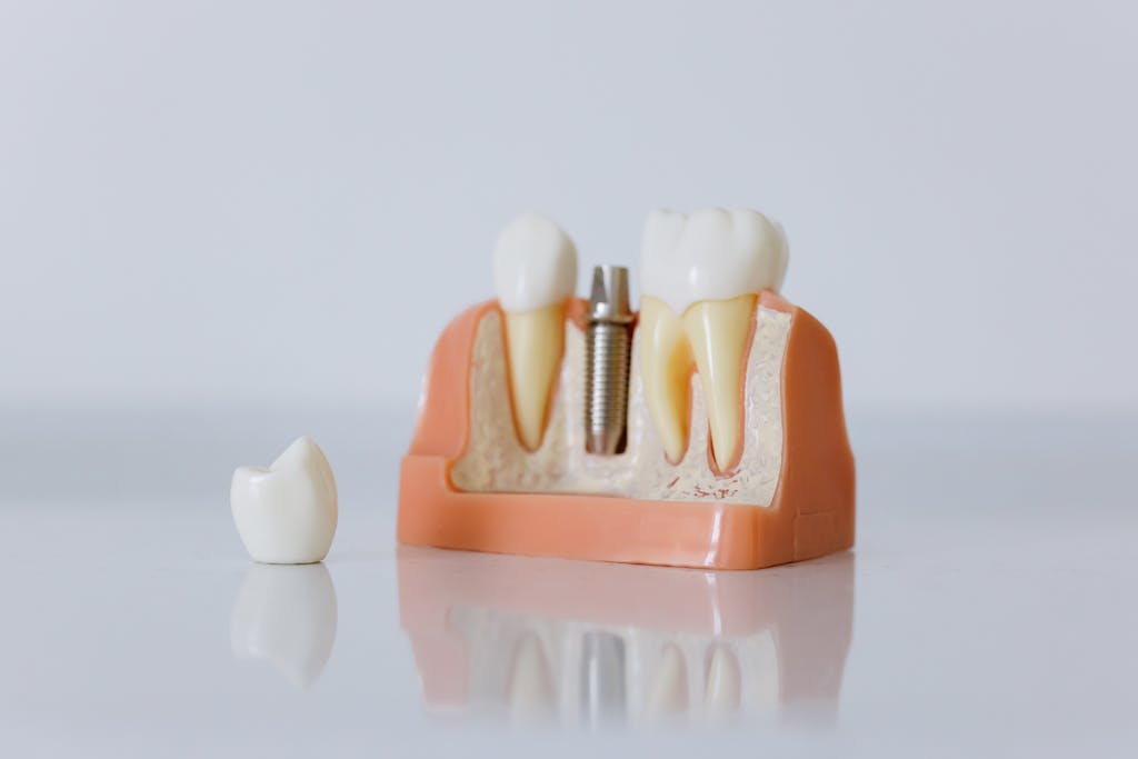 Close-up of a dental implant model with a metal implant post, artificial teeth, and a detached crown.
