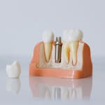 Close-up of a dental implant model with a metal implant post, artificial teeth, and a detached crown.