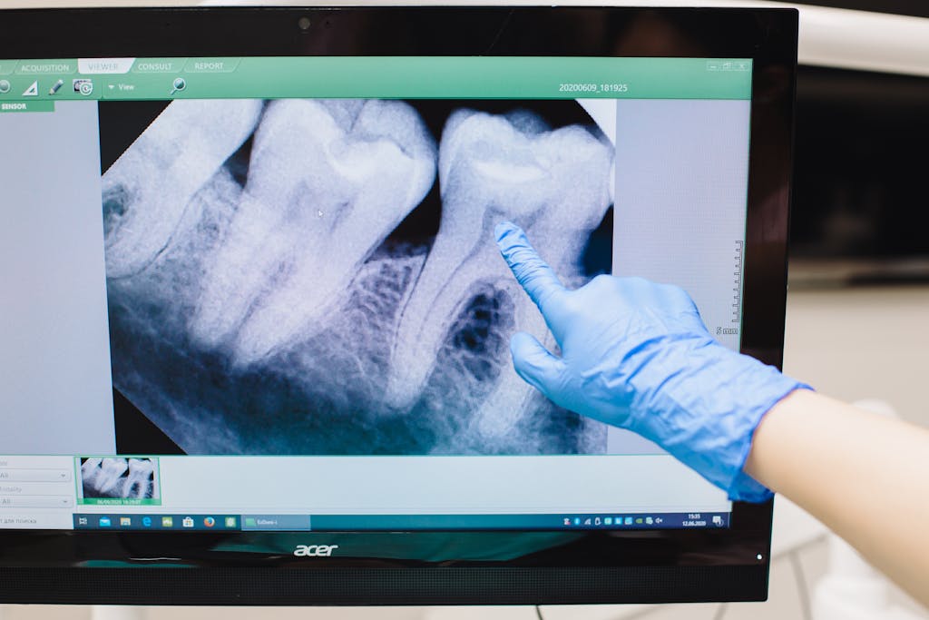 Dental X-ray displayed on a monitor with a gloved hand pointing at a tooth.