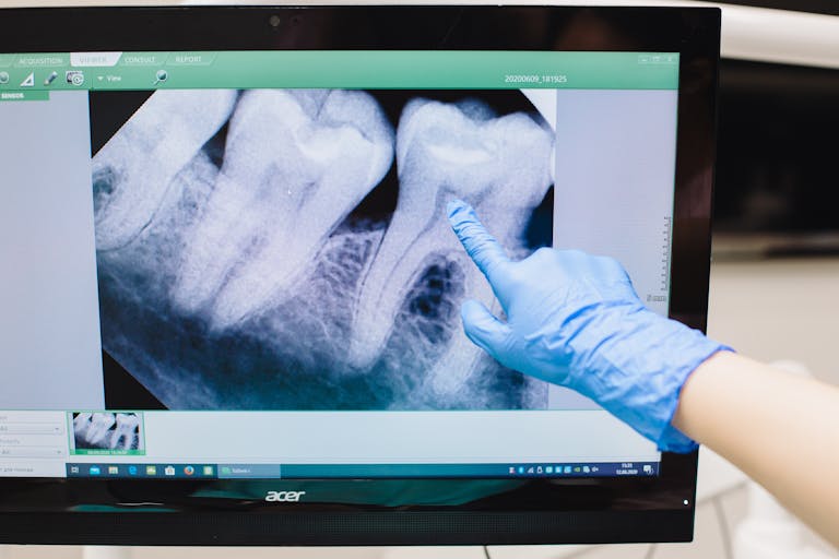 Dental X-ray displayed on a monitor with a gloved hand pointing at a tooth.