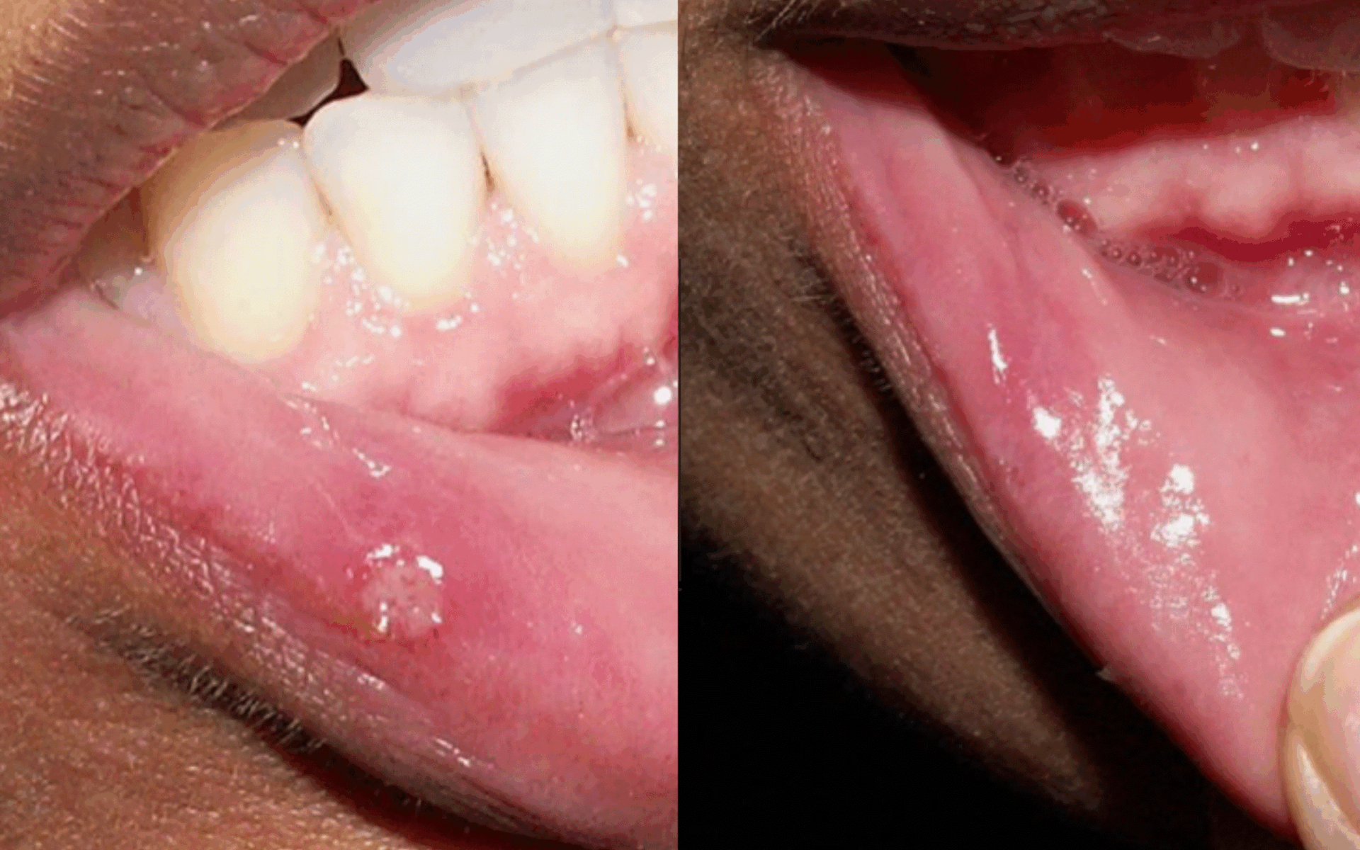 Fotona clinical example: aphthous ulcer (canker sore) before and after