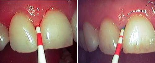 Fotona clinical image: soft-tissue curettage debridement before and after (TwinLight-related periodontal application)
