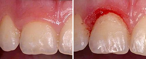 Fotona clinical image: crown lengthening before and after (laser periodontal application)