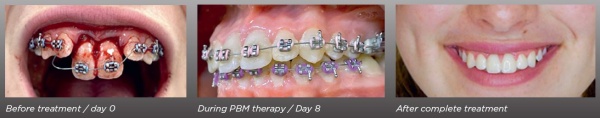 Photobiomodulation clinical example: dental trauma treatment progression