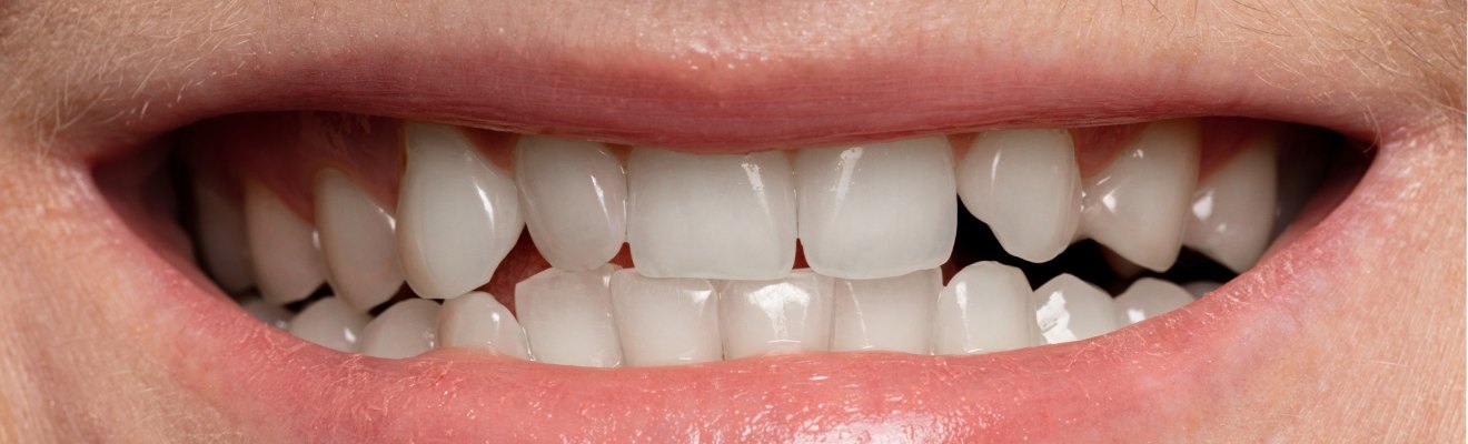 Representative teeth-whitening comparison, after view
