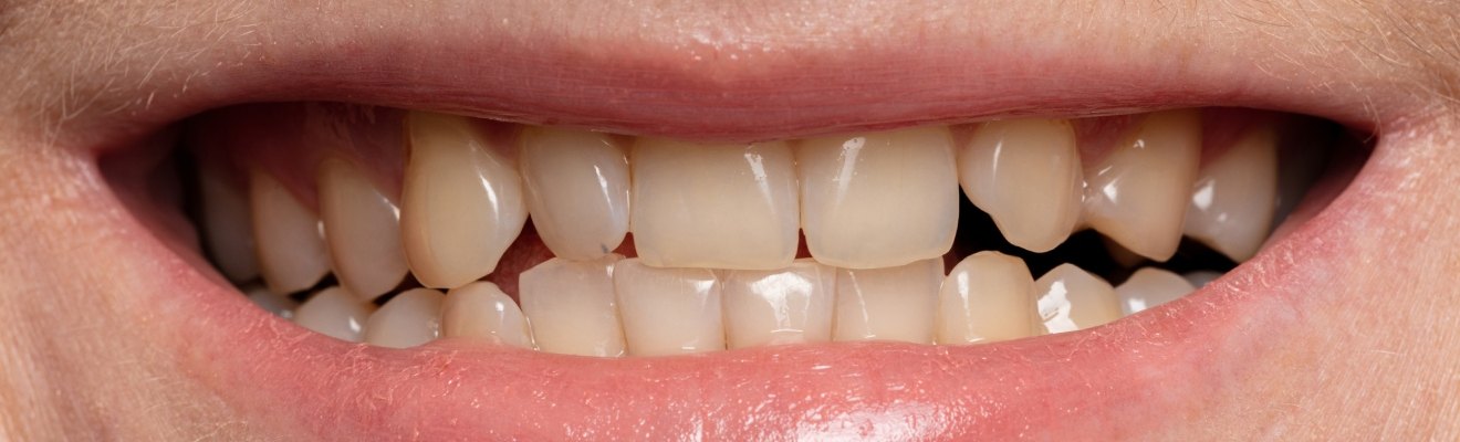 Representative teeth-whitening comparison, before view