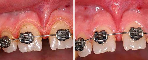 Fotona clinical image: gingivoplasty before and after (laser periodontal/soft tissue application)