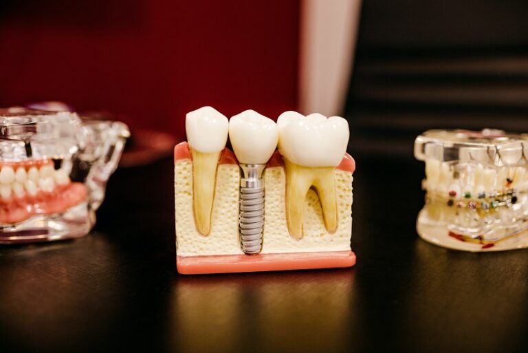 Dental teaching model showing a crown attached to an implant post in the jaw beside natural teeth